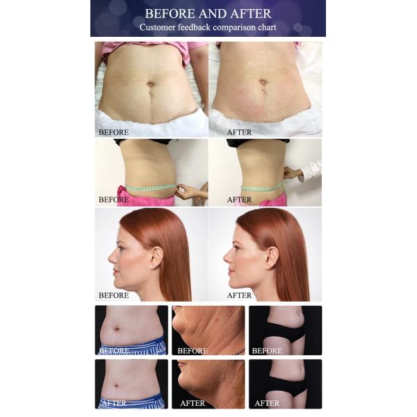 2020 New Technology Cryotherapy Criolipolisis Body Shaper Shock Wave Therapy Equipment