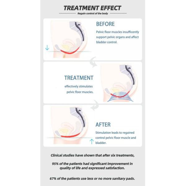 EMS Pelvic Chair Pelvic Floor Muscle Strenthening High-Intensity Focused Electromagnetic Urinary Incontinence Treatment
