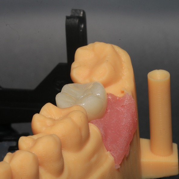 Silver Custom Titanium Abutments Dental Implants With Full Zirconia Crown