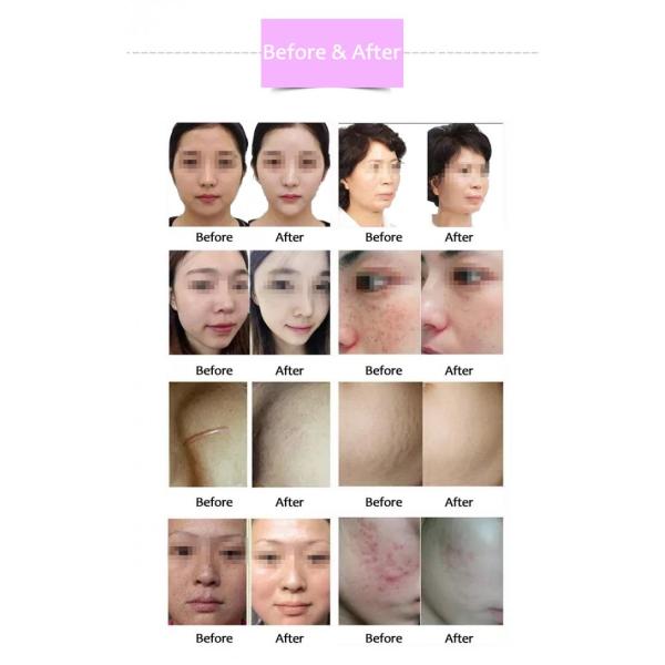 Piel del salón que aprieta la máquina micro del RF de la aguja, máquina fraccionaria de la radiofrecuencia