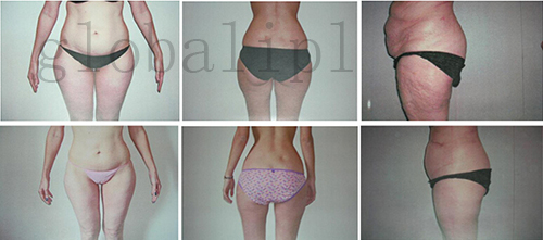 Weight Loss Vacuum cavitation system , hifu liposonix focus ultrasound body shaping machine