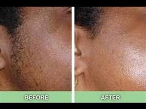 Body Fine Hairs Nd Yag Laser Hair Removal Machine Long Pulse 1064nm White Color