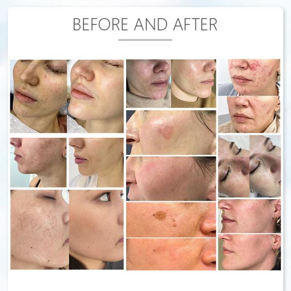 портативная машина удаления волос лазера диода 480nm для лицевой поднимаясь кожи