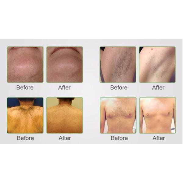 Factory price--the newest 755 1064 808 diode laser hair removal machine- whatsup86 18332565274