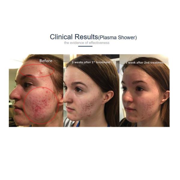 AC100-240V Multifunctional Beauty Machine Plasma Pen For Beauty Salon