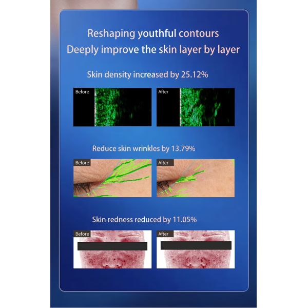 Non Surgical Radiofrequency Microneedling Device HIFU Skin Rejuvenation Device