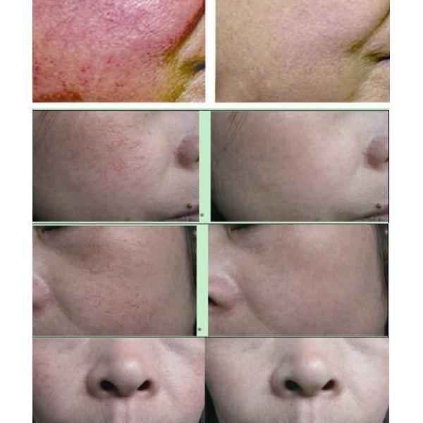 Vascular removal! 30 MHZ spider vein removal machine / laser spider vein removal for sale