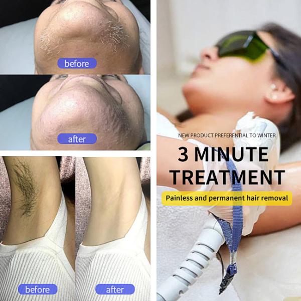 Painless YAG IPL Diode Laser Device Portable 755 808 1064nm Laser Hair Removal Epilator