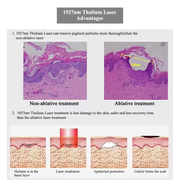 Portable New 1927nm Thulium Laser for Melasma Laser 1927 Thulium Micro Ablative 1927 Non Ablative Laser Thulium Facial Laser