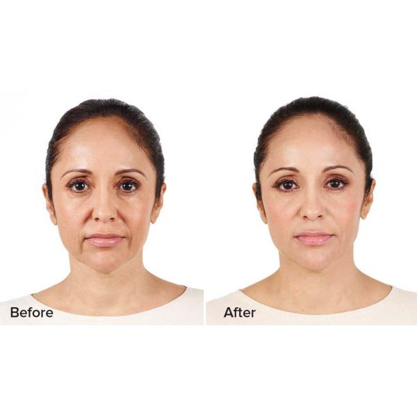 Hyaluronic кисловочная сыворотка 5ml используемая для кожи не crosslink