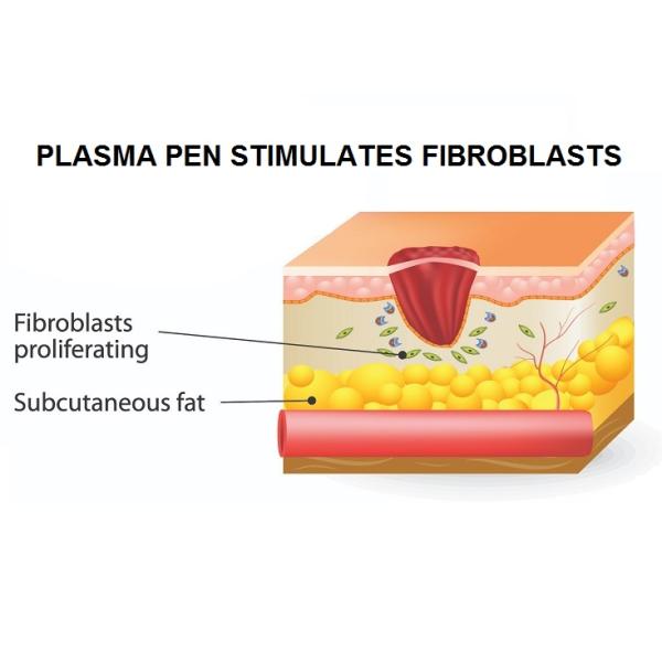 Ozone Wart Cold Spray Pen Skin Rejuvenation Latest Plasma Pen