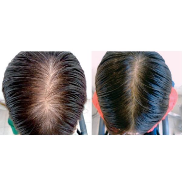 FDA CE Hair Growth Devices LLLT 405mW Laser Caps For Hair Loss