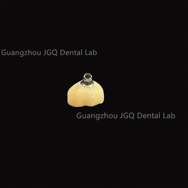 Customized Titanium Abutment Implanted Dentures for Durable Dental Solutions