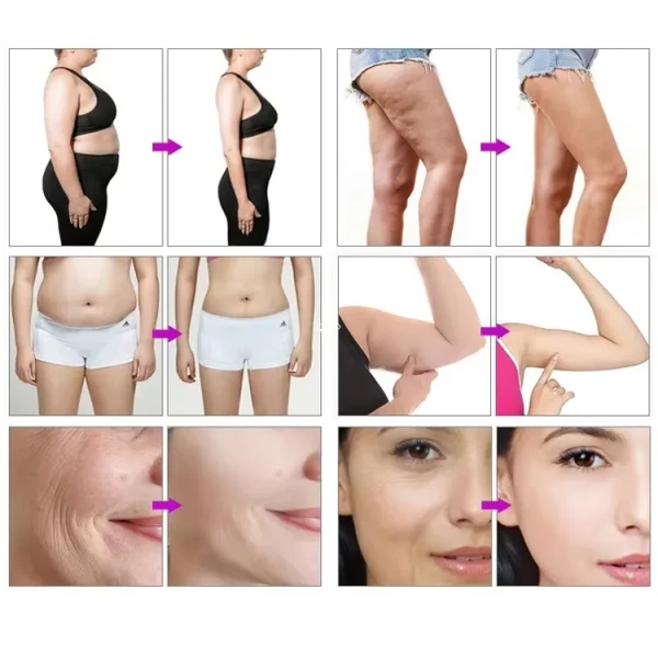 Factory Directly Selling Newest Updates Professional Advanced Technology Endermology LPG Therapy Treatment Facial Beauty Device