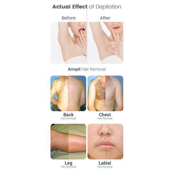 Лазерный тип диодный лазер 755nm 808nm 1064nm для домашнего мини ручной удаления волос