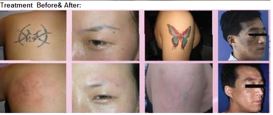 Y11 - Portble 1064 / 532 / 1320nm Q Switch ND YAG Laser Tattoo Removal Machine