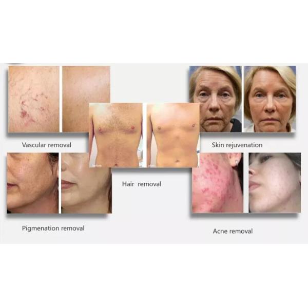 Vertical OPT SHR IPL Hair Removal Machine / Skin Rejuvenation Equipment