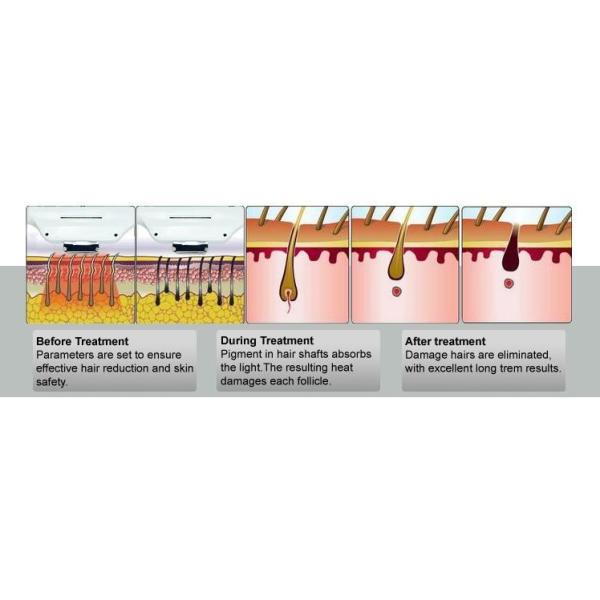 Salon Beauty Facial Hair Removal Devices 1000W - 3000W Power Water Flow Safety Control