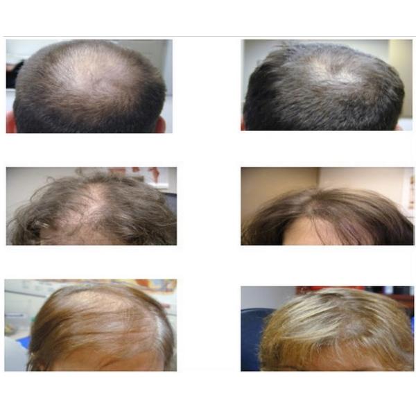 Прибор 650nm терапией диода машины Regrowth лазера волос красоты фотодинамический