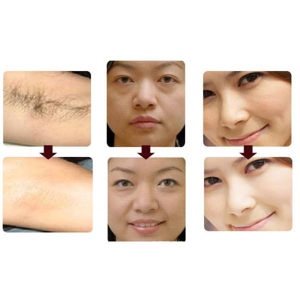 Vertical Elight IPL Laser Hair Removal Machine For freckle removal