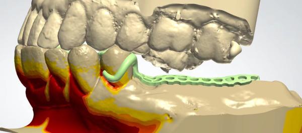 Digital Metal Framework CAD CAM Dental Design Cocr Material With 3D Printing