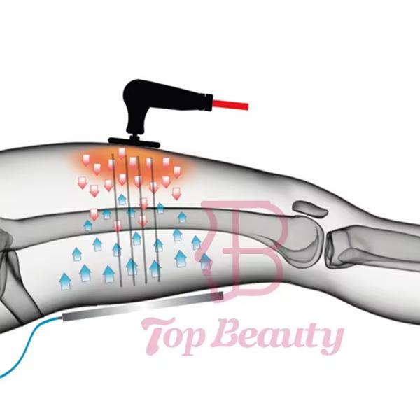 3 In 1 Tecar Diatermia Back Pain Relief 448k Indiba Radiofrecuency Ret Cet Rf Bracelet Vaginal Tightening Machine
