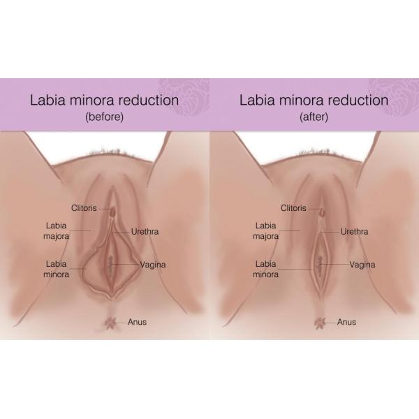 2 in 1 female intimate areal Tigthen RF Radio Frequency Technology Labia Tighten Rejuvenation Device