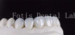 Ultra Strong Translucent Dental Laminate Veneers Natural Color