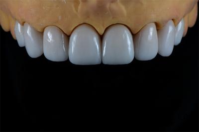 Natural Porcelain E-Max Crown Full Veneer In Demistry Restorations