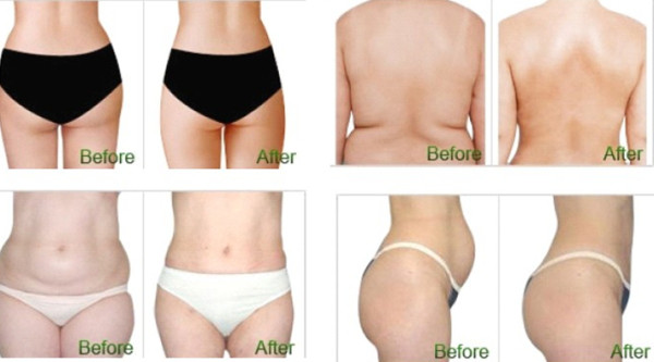 25m3/H 100kPa Anti Cellulite Vacuum Slimming Machine