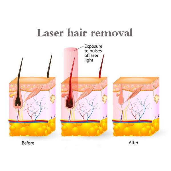 Painless Diode Laser Hair Removal Machine Full Body Permanent Hair Removal Devices