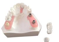 La couronne en zirconium avec dentition implantée pour laboratoire dentaire