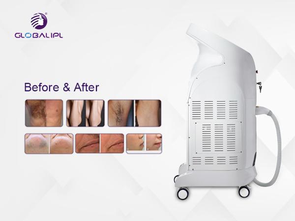 Big Spot Size Diode Laser Hair Removal Machine Painless Ipl Skin Rejuvenation