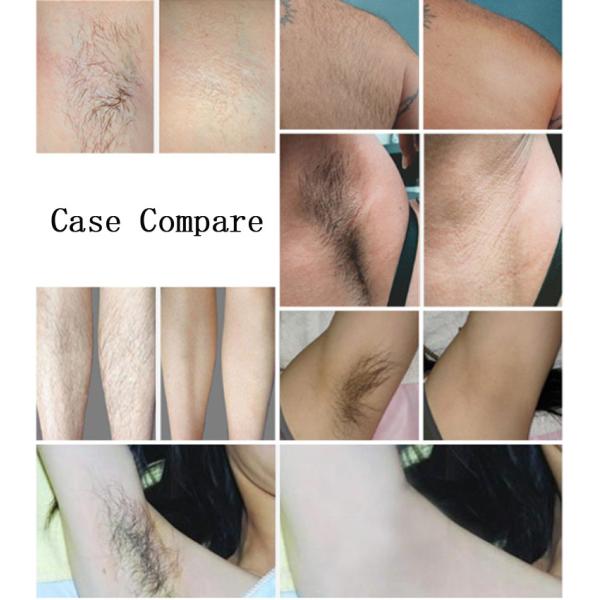 1000W оборудование 2-88j/Cm2 удаления волос диода 808 Nm постоянное