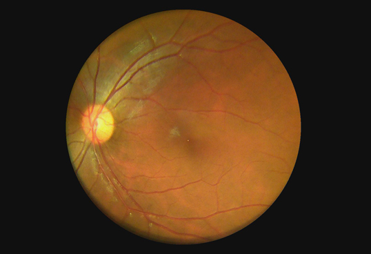 Идеальная система для камеры Fundus применения телемедицины портативной с технологией автоматического фокуса 45° Не-mydriatic