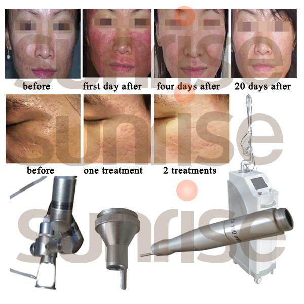 Fractional co2 laser CO2 laser scar removal CO2 laser acne treatment machine for sale