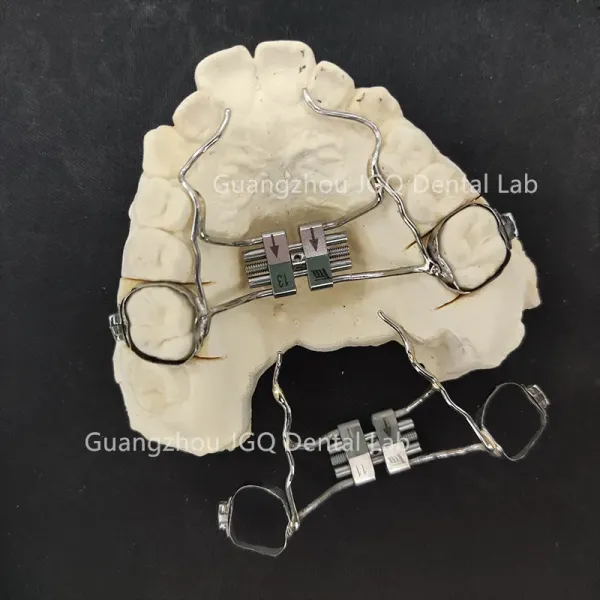 3D Printing Minimal Prep Orthodontic Arch Expander For Teenager
