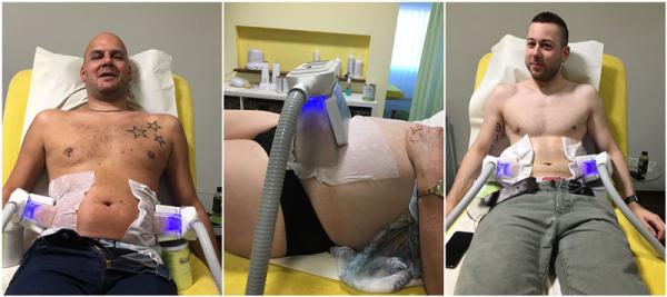 5 handles Cryolipolysis slimming device Coolsculpting fat freeze slimming equipment CE FDA approved