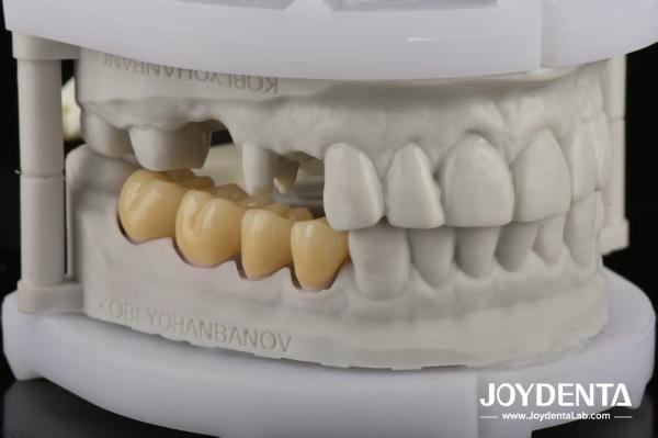 Dentaduras de zirconia que imitan los dientes naturales