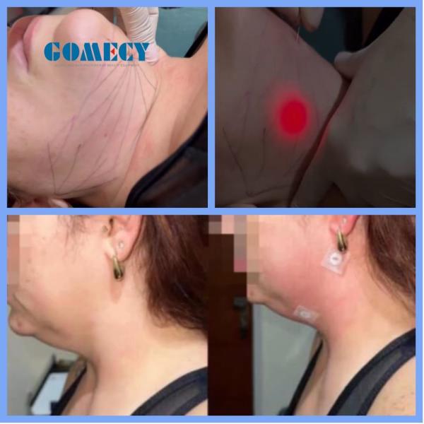 Machine à laser de levage d'endomètre pour les veines d'araignée / le visage, l'élimination des veines et la lipolyse / la liposuccion