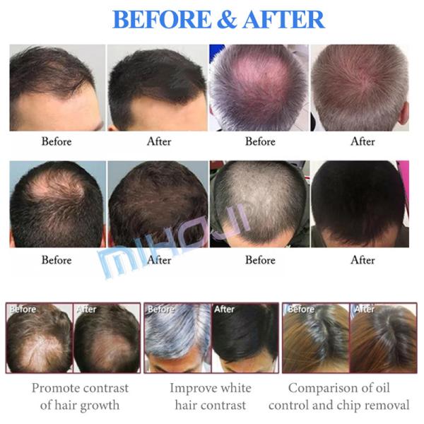 Máquina de Tratamento de Perda de Cabelo de Infravermelho Multifuntcional para Eliminação de Acne