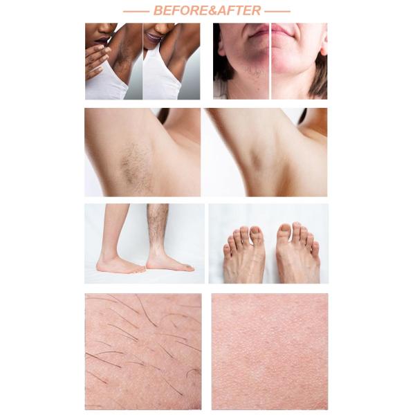 Beauty Salon Equipment Fiber Diode Laser Hair Removal Machine with Germany Laser Bar