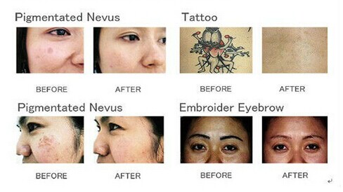 Alto - máquina da remoção da tatuagem do laser do Nd Yag do Q-Interruptor 1064nm&532nm do laser da tecnologia