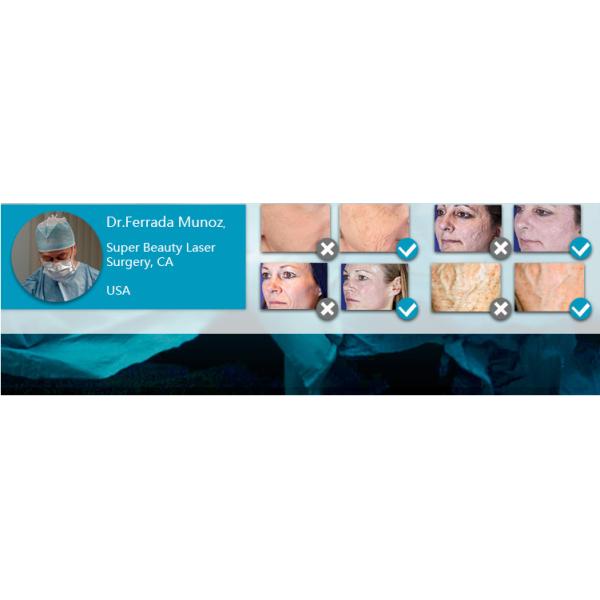 USA Coherent Metal Tube Co2 Fractional Laser Machine for Scar Removal