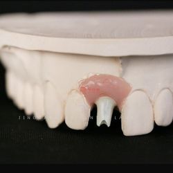 Custom Dental Implant Screw Retained Crown Hybrid Dentures Zirconia Angled Abutment China Lab