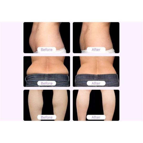 Rf 40k Ultrasonic Fat Cavitation Machine Cavstorm 3.0 Vacuum Cup Weight Loss