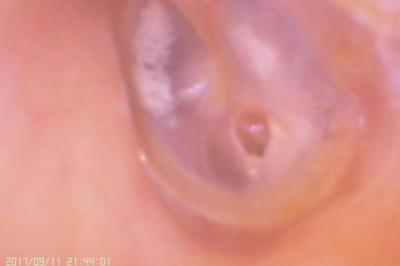Video Ear And Nose C amera Digital Otoscope For Perforation Of The Tympanic Membrane