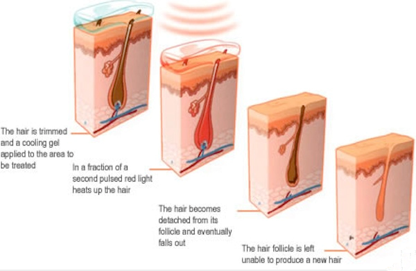 удаление волос 1000w Ipl подвергает интенсивное пульсированное светлое удаление механической обработке волос подмышки