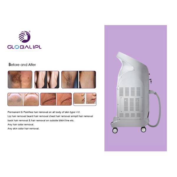 оборудование удаления волос 755нм 808нм УС08, обработка лазера диода для удаления волос