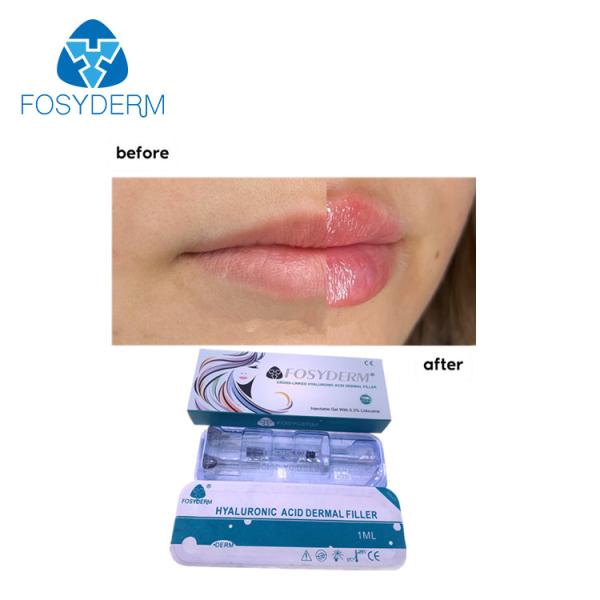 Injeção ácida hialurónica cutânea dos enchimentos 1ml do bordo de Fosyderm para o realce do bordo